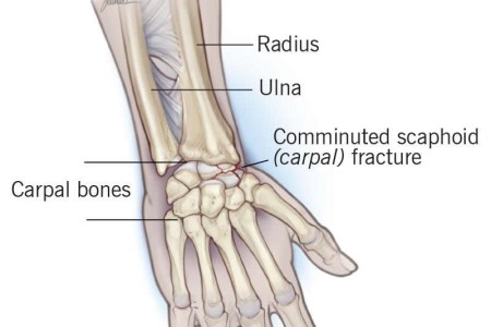 Broken Wrist (Wrist Fracture)