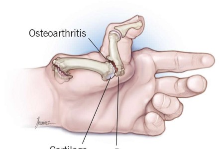 Thumb Arthritis