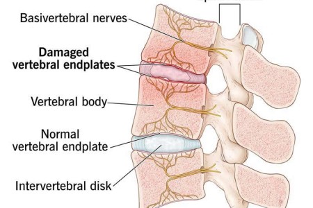 Vertebrogenic Low Back Pain