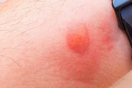 Horsefly Bite