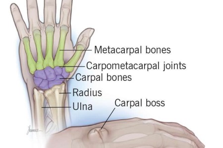 Carpal Boss