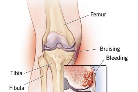 Bone Bruise (Bone Contusion)