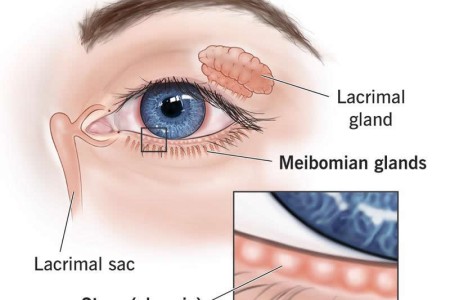 Meibomian Gland Dysfunction