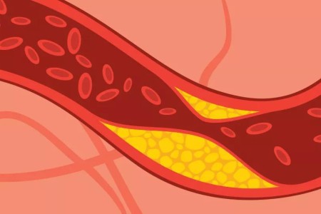 What It Means if You Have ‘Sticky’ Cholesterol