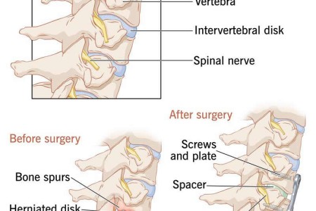 ACDF (Anterior Cervical Discectomy & Fusion) Surgery