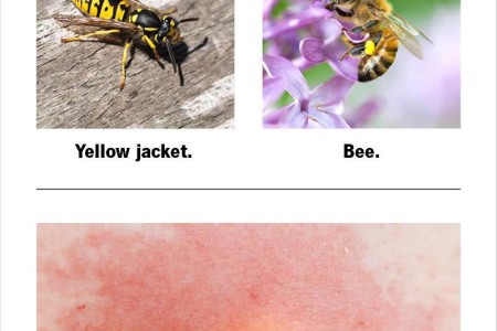 Yellow Jacket Sting