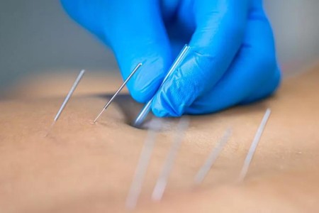 What’s the Difference Between Dry Needling and Acupuncture?