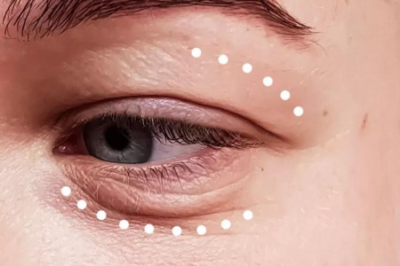 Blepharoplasty vs. Brow Lift: What To Know