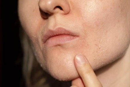 Do You Have a Winter Rash? Here’s How To Treat and Prevent It