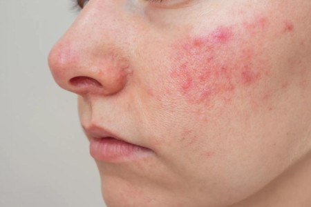 6 Natural Ways To Find Relief From Rosacea