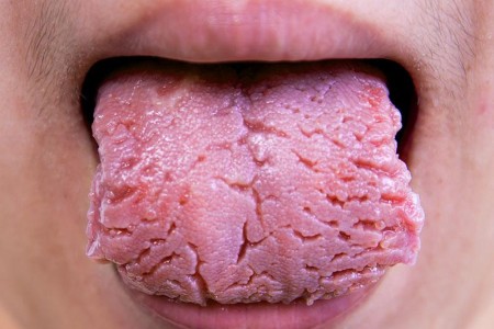 Fissured Tongue