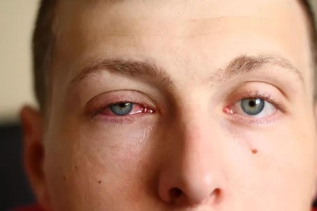 Here’s How To Get Rid of Pink Eye Fast
