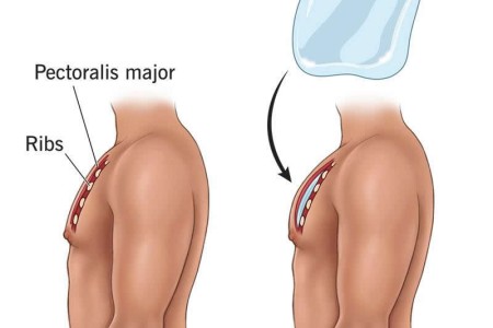 Pec (Pectoral) Implants