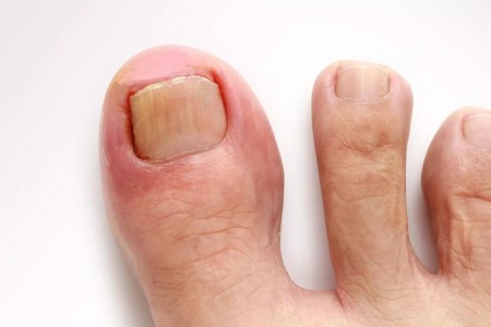 Ingrown Toenail? Try These Home Remedies