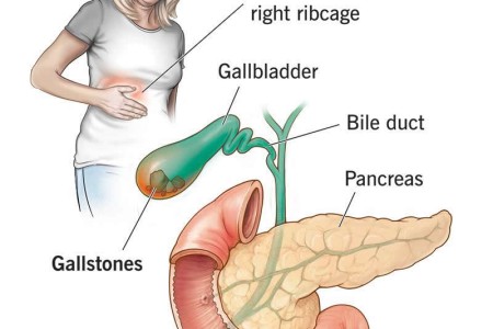 Biliary Colic