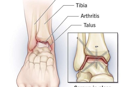 Arthrodesis (Joint Fusion)