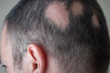 Self-Care Tips To Manage Alopecia Areata