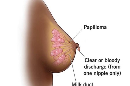 Intraductal Papilloma