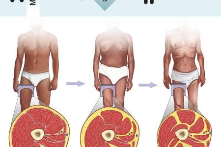 Cachexia (Wasting Syndrome)