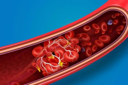 The Connection Between COVID-19 and Blood Clots