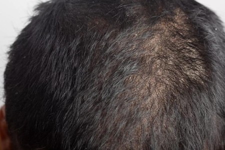 Experiencing Scalp Psoriasis? Learn How To Treat and Reduce Hair Loss