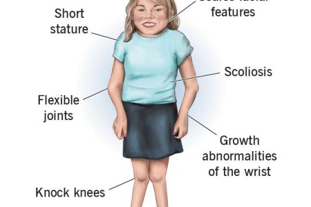Morquio Syndrome