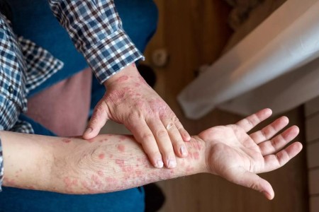Does Psoriasis Spread on Your Body?
