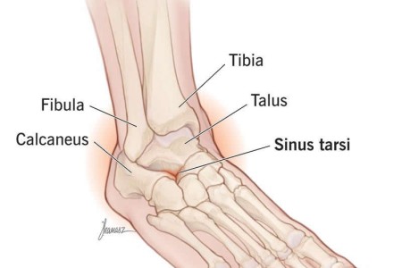 Sinus Tarsi Syndrome