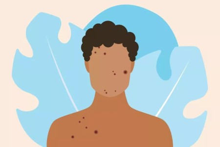 Adult Acne: What Causes It and What To Do About It