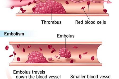 Embolism
