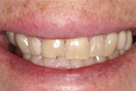 Chipped Tooth