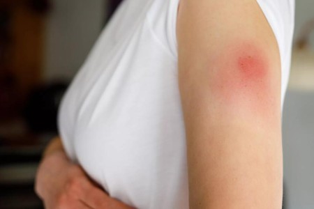 Should You Be Worried About COVID Arm?