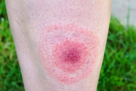 What It’s Like Living With Lyme Disease