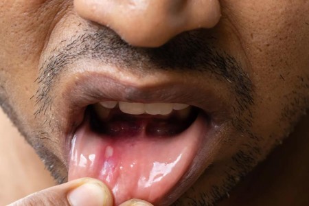 Is It a Canker Sore or Cancer? Look for These Signs