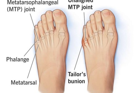 Tailor's Bunion (Bunionette)