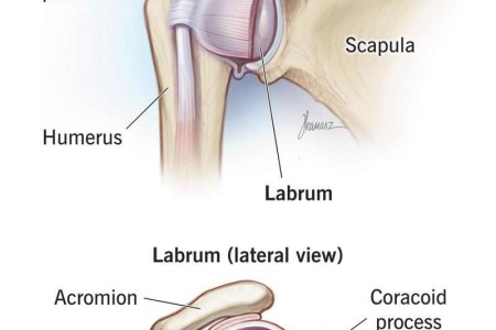 Bankart Lesion (Glenoid Labrum Tear)
