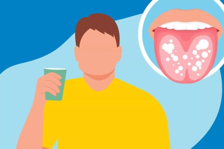 How To Get Rid of Thrush: 8 Remedies