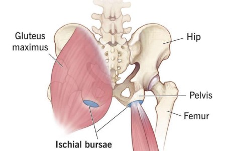 Ischial Bursitis