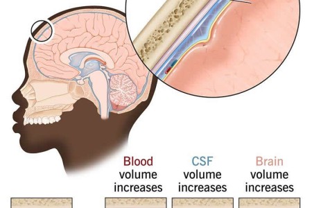 Increased Intracranial Pressure (ICP)