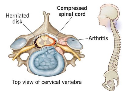 Cervical Myelopathy (Cervical Spondylotic Myelopathy)