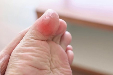 5 Ways To Avoid Blisters (and the Best Way To Treat Them)