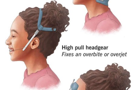 Orthodontic Headgear