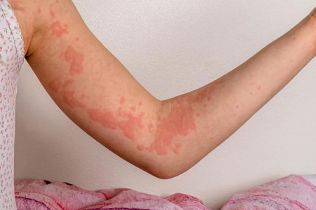 Can Certain Foods Trigger or Prevent Chronic Hives?