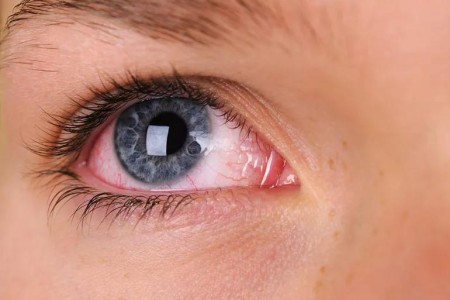 Why Your Eyes Are Always Red (and How To Fix Them)