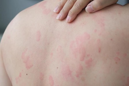 The Usual Suspects: Looking Out for the Top Chronic Hives Triggers