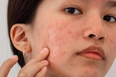 Have PCOS? Here’s Everything You Need To Know About Acne and Other Skin Symptoms