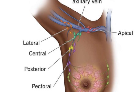 Axillary Lymph Node Dissection