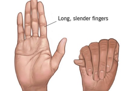 Arachnodactyly