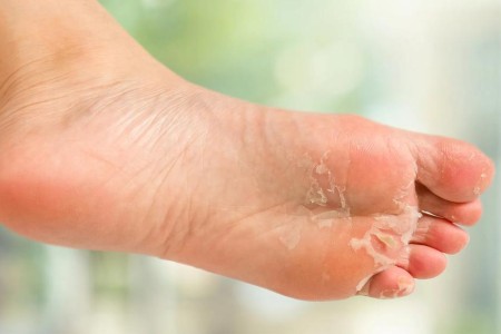 Why Are My Feet and Toes Peeling?