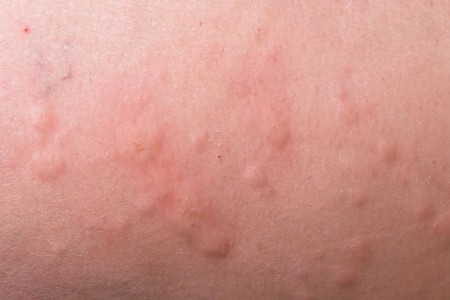 Are Stress Hives a Real Thing?